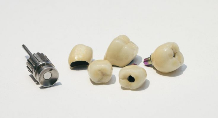 Chińskie implanty zębów- co warto o nich wiedzieć?